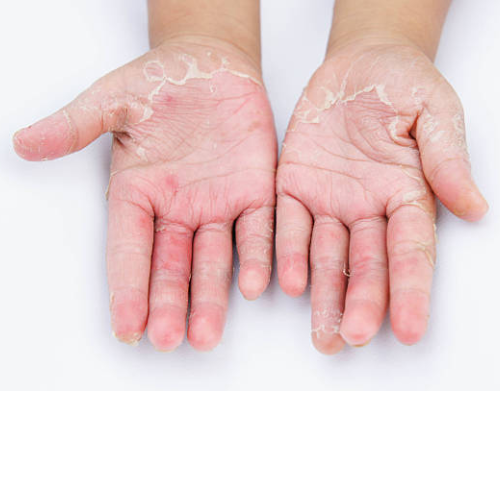 Kontakt dermatitisz - Dermatica Központ